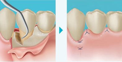 歯周外科（フラップ手術）